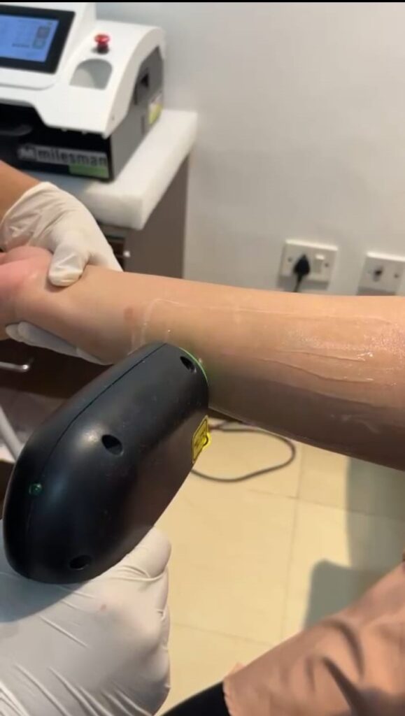 New Laser Hair Removal Technology 4